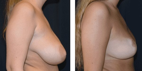 Bröstförminskning Assymetri