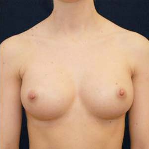 Efter Bröstförstoring anatomiska implantat