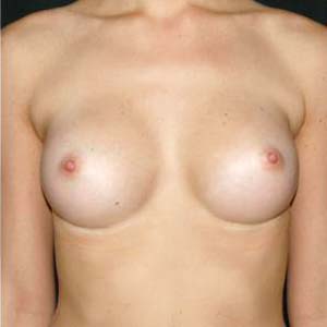 Efter Bröstförstoring anatomiska implantat