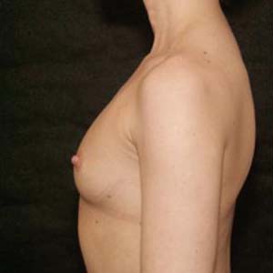 Före Bröstförstoring anatomiska implantat