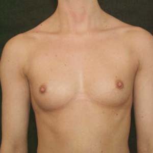 Före Bröstförstoring anatomiska implantat
