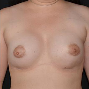 Tuberösa bröst