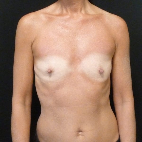 Bröstimplantat Malmö