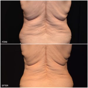 Före- och efterbilder CoolSculpting