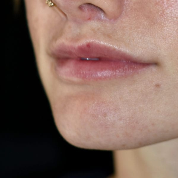 Läppar snett från sidan efter läppkirurgi-måsvingeplastik_35852