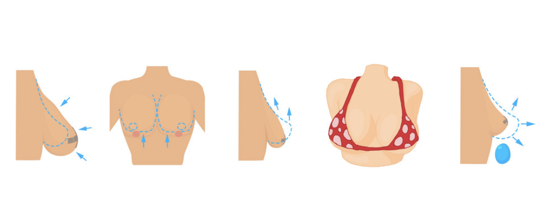 Illustration för bröstlyft