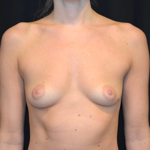 Kvinna innan bröstförstoring