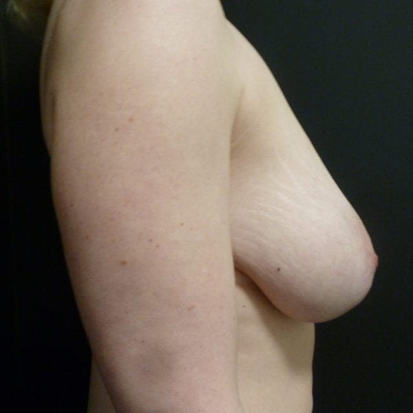 Patient från sidan innan bröstförminsking_181891