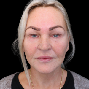 ansiktslyft kvinna 58 före-efter